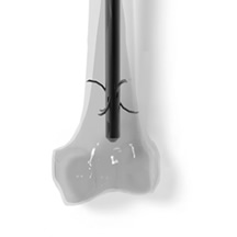 Distal Fix