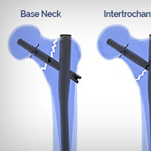 Distal Fix