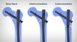 Distal Fix
