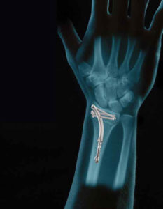 WRx (wrist/distal radius)