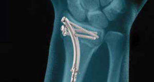 WRx (wrist/distal radius)