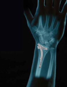 WRx (wrist/distal radius)